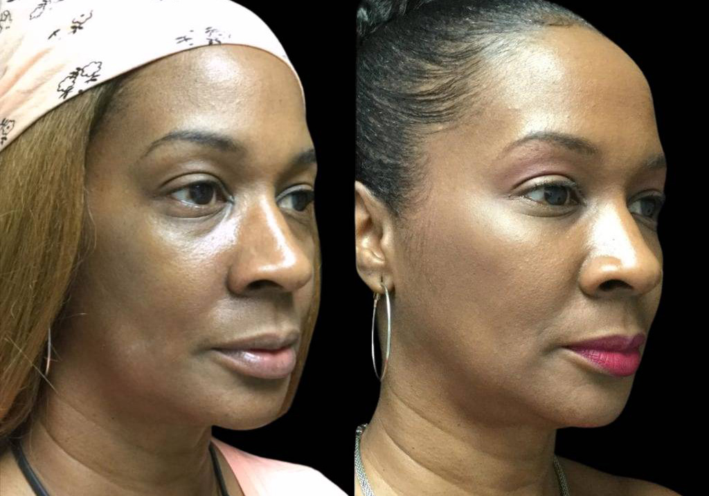 54-year-old-female-restylane-lift-before-and-after-three-quarter-view.jpg
