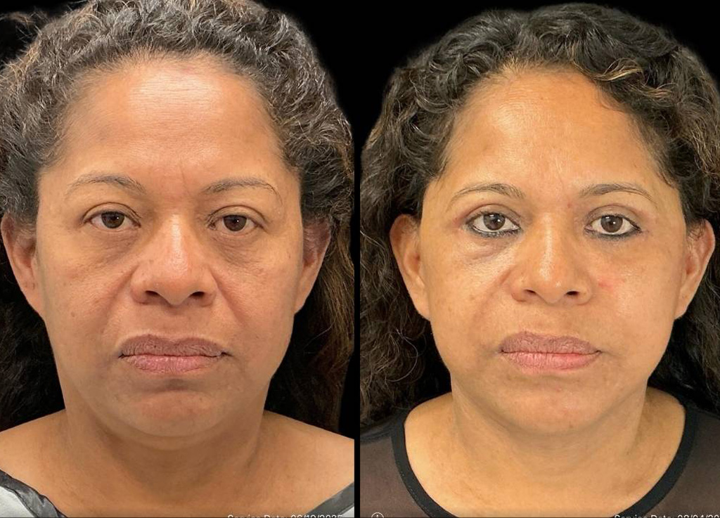 54-yr-old-female-deep-plane-facelift-before-and-after-front-view.jpg