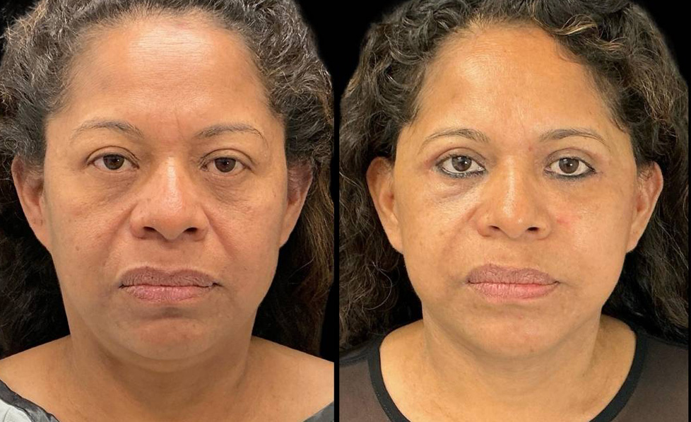 54-yr-old-female-deep-plane-facelift-before-and-after-front-view.jpg