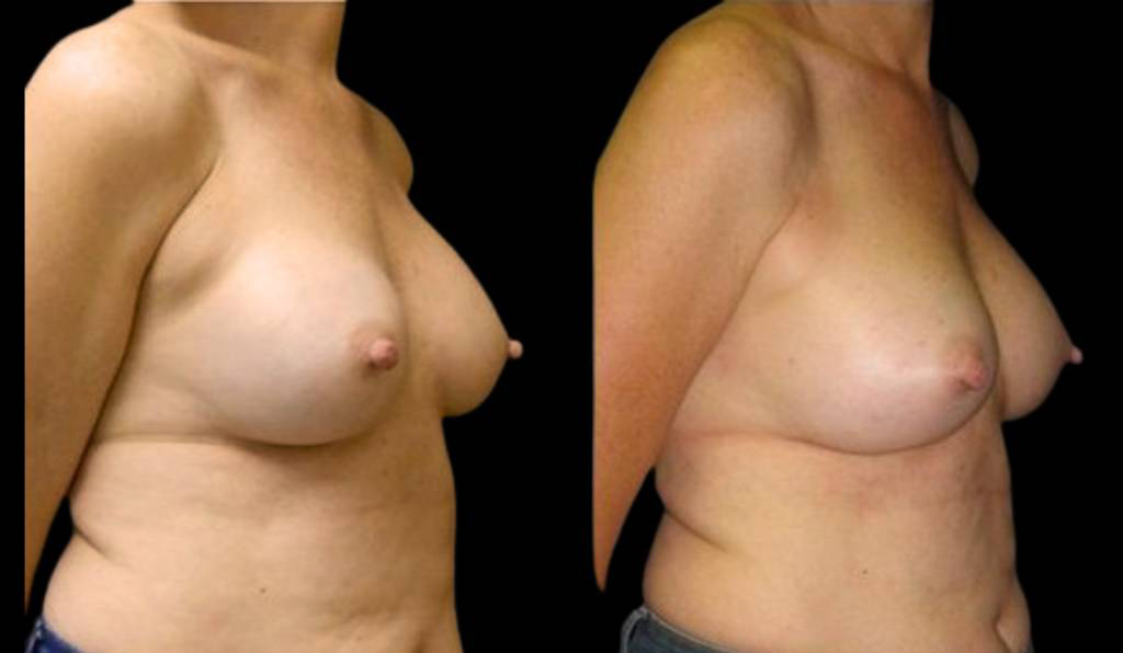 55-year-old-female-breast-implant-exchange-before-and-after-three-quarter-view.jpg