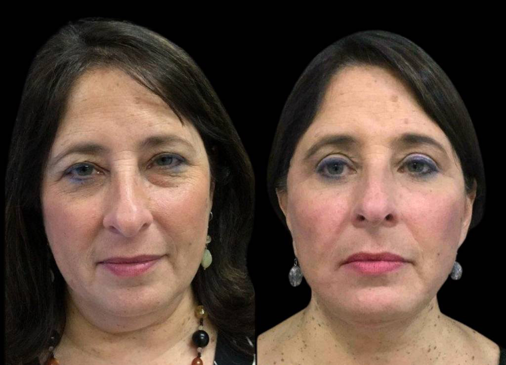 55-year-old-female-facelift-before-and-after-front-view-15979.jpg