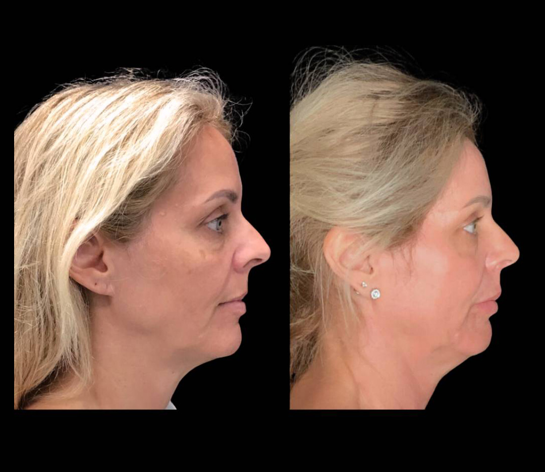 55-year-old-female-fractional-co2-laser-before-and-after-side-view.jpg