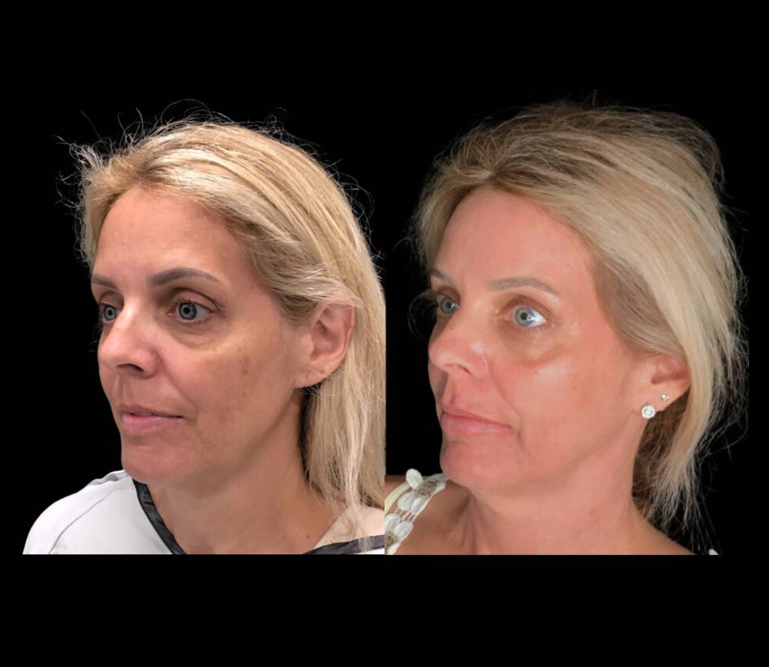 55-year-old-female-fractional-co2-laser-before-and-after-three-quarter-view-19389.jpg