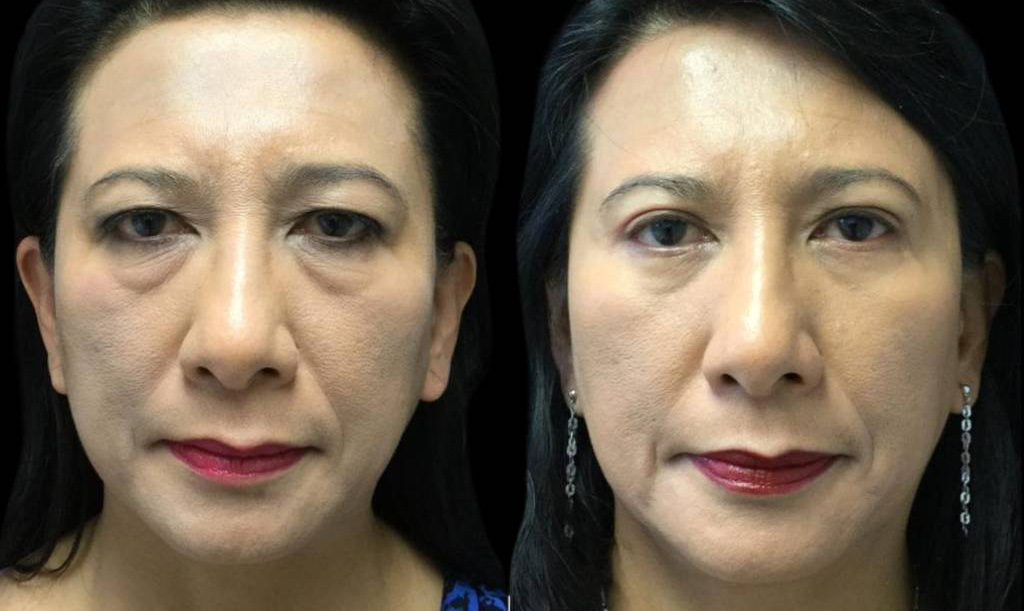 55-year-old-female-lower-eyelid-lift-before-and-after-front-view-27068.jpg