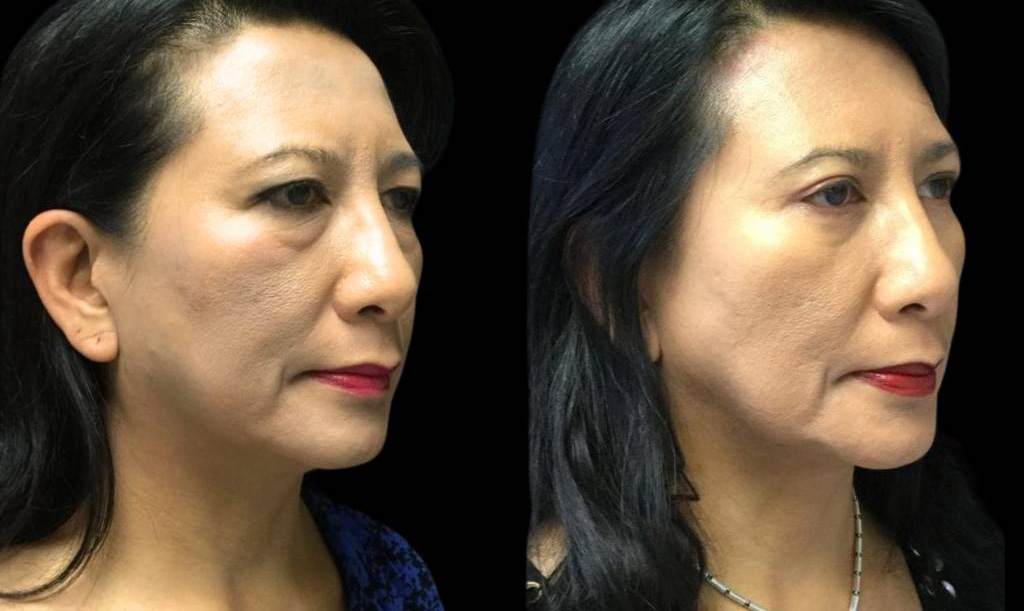 55-year-old-female-lower-eyelid-lift-before-and-after-three-quarter-view.jpg