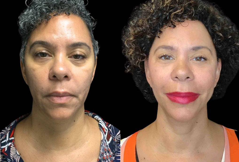 55-year-old-female-necklift-before-and-after-front-view-24973.jpg