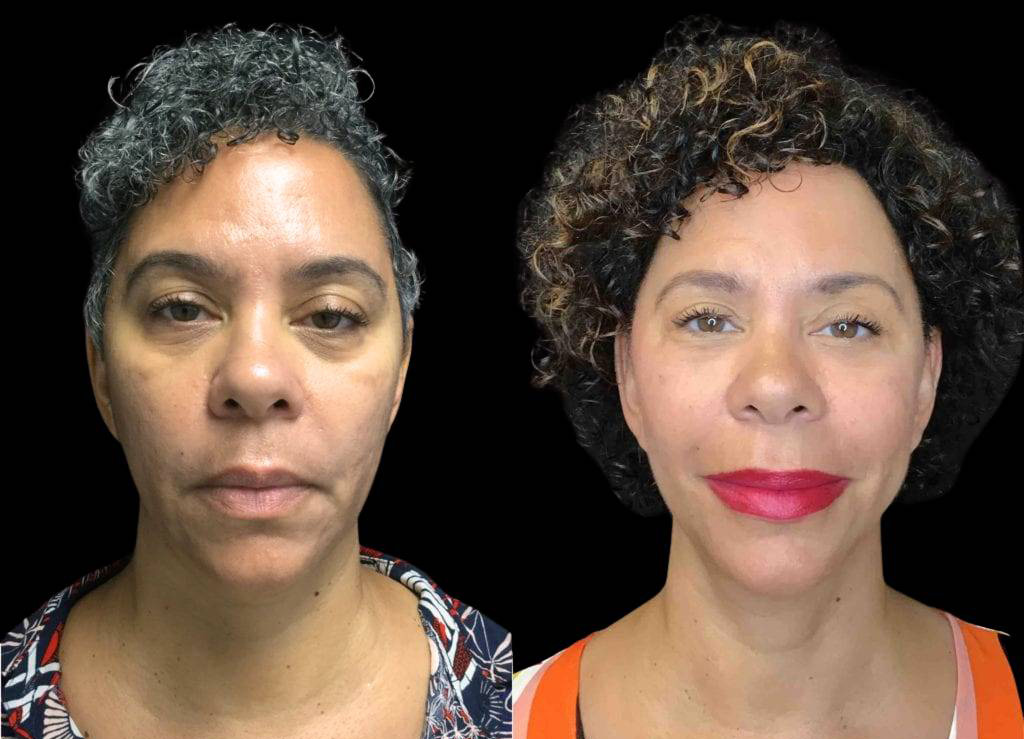 55-year-old-female-necklift-before-and-after-front-view-24973.jpg