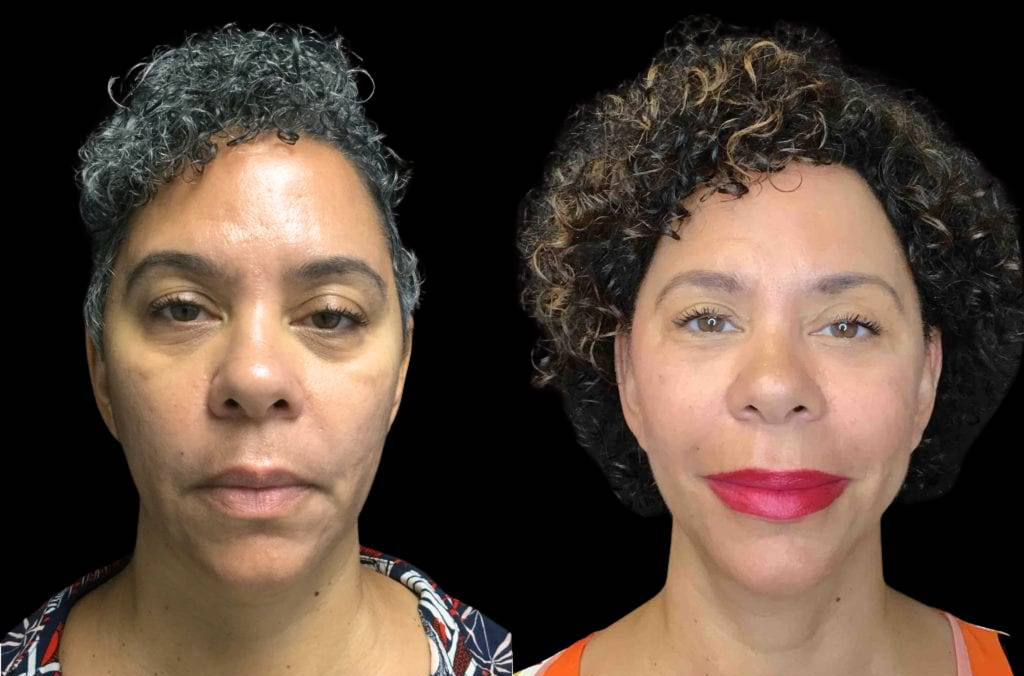 55-year-old-female-necklift-before-and-after-front-view-24973.jpg
