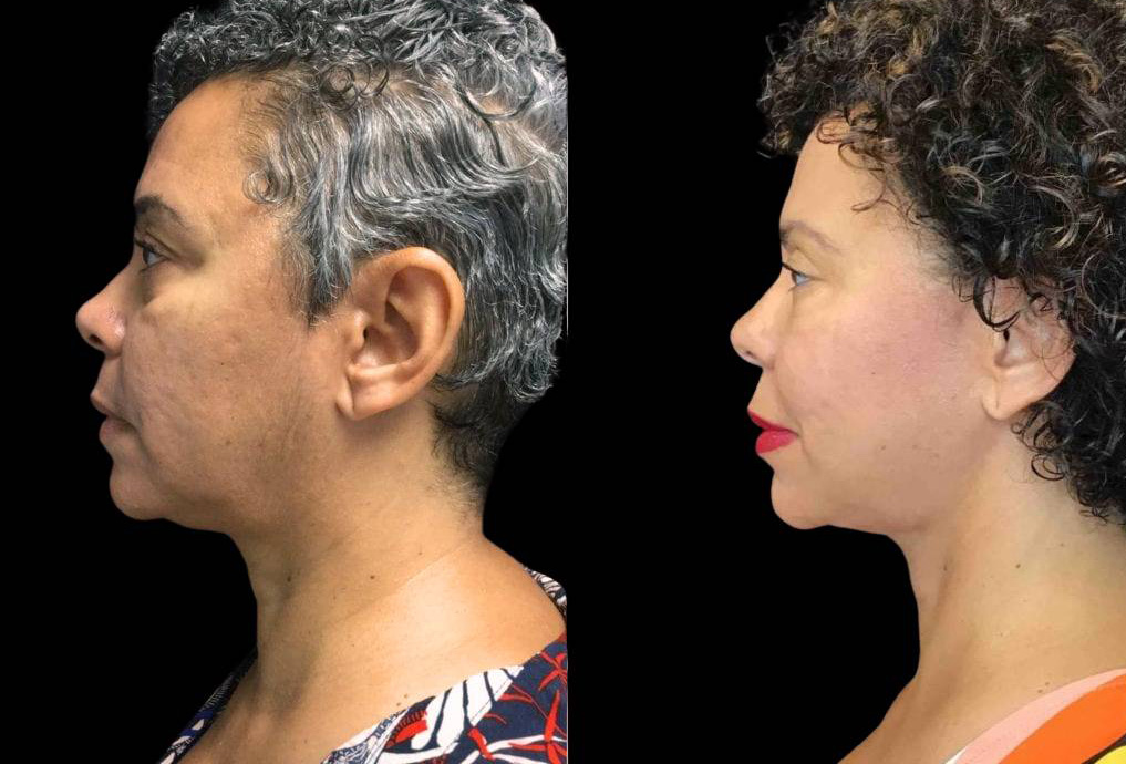 55-year-old-female-necklift-before-and-after-side-view.jpg