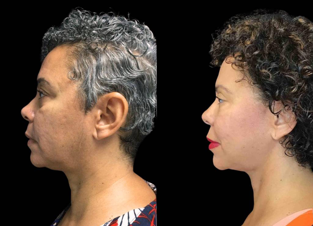 55-year-old-female-necklift-before-and-after-side-view.jpg