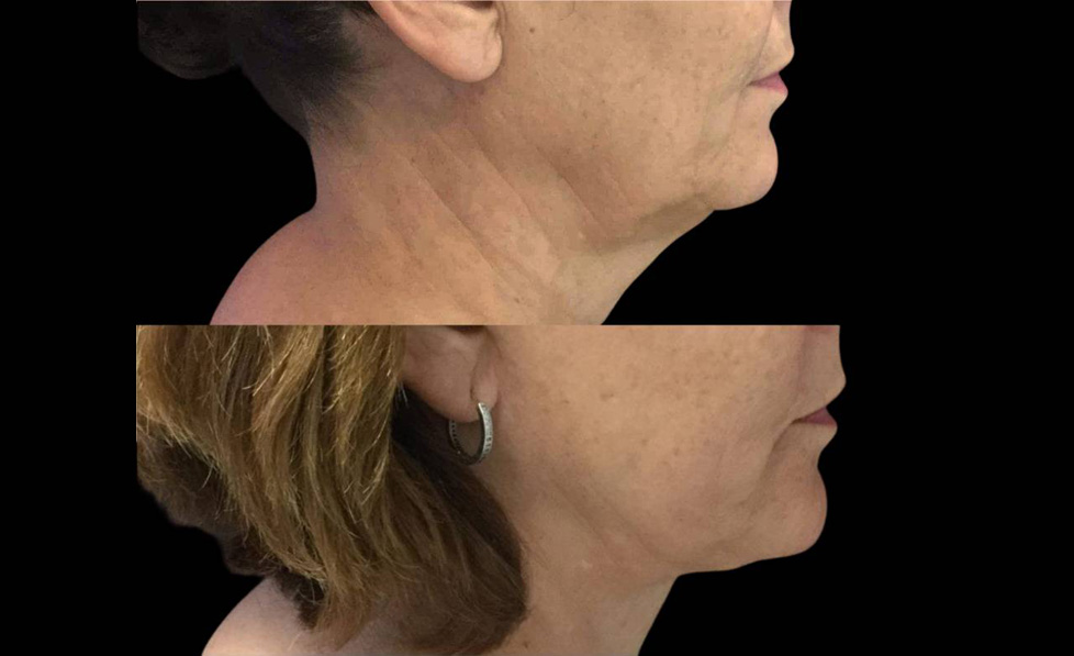 55-year-old-female-necklift-before-and-after-side-view-26074.jpg