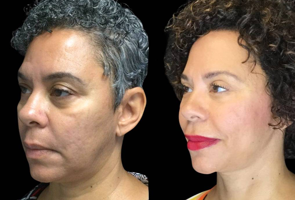 55-year-old-female-necklift-before-and-after-three-quarter-view.jpg