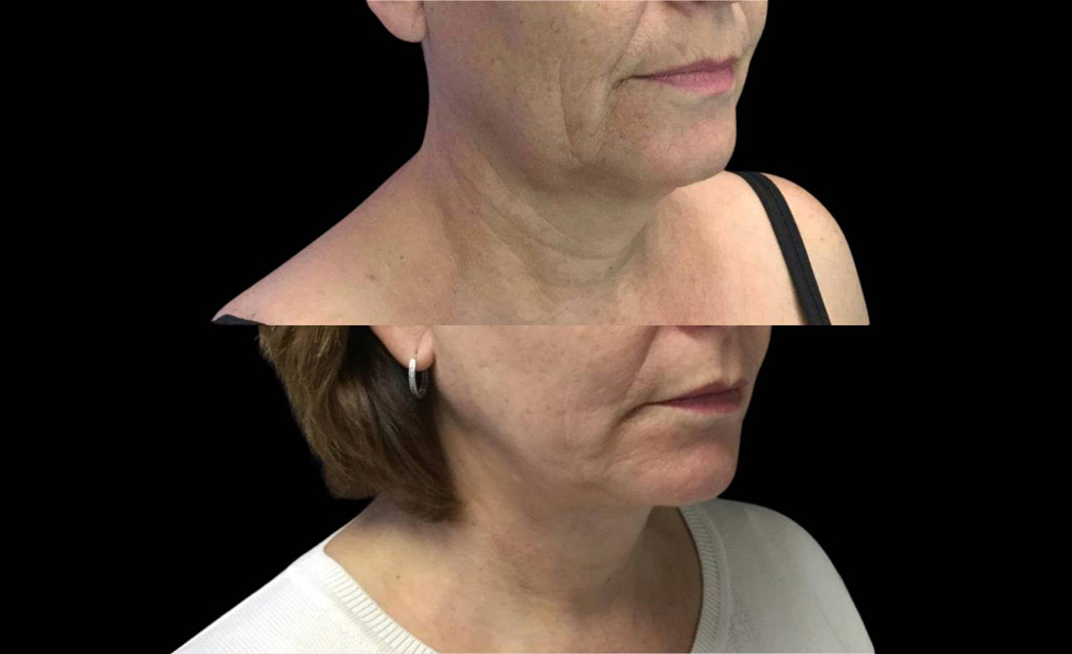 55-year-old-female-necklift-before-and-after-three-quarter-view-1.jpg