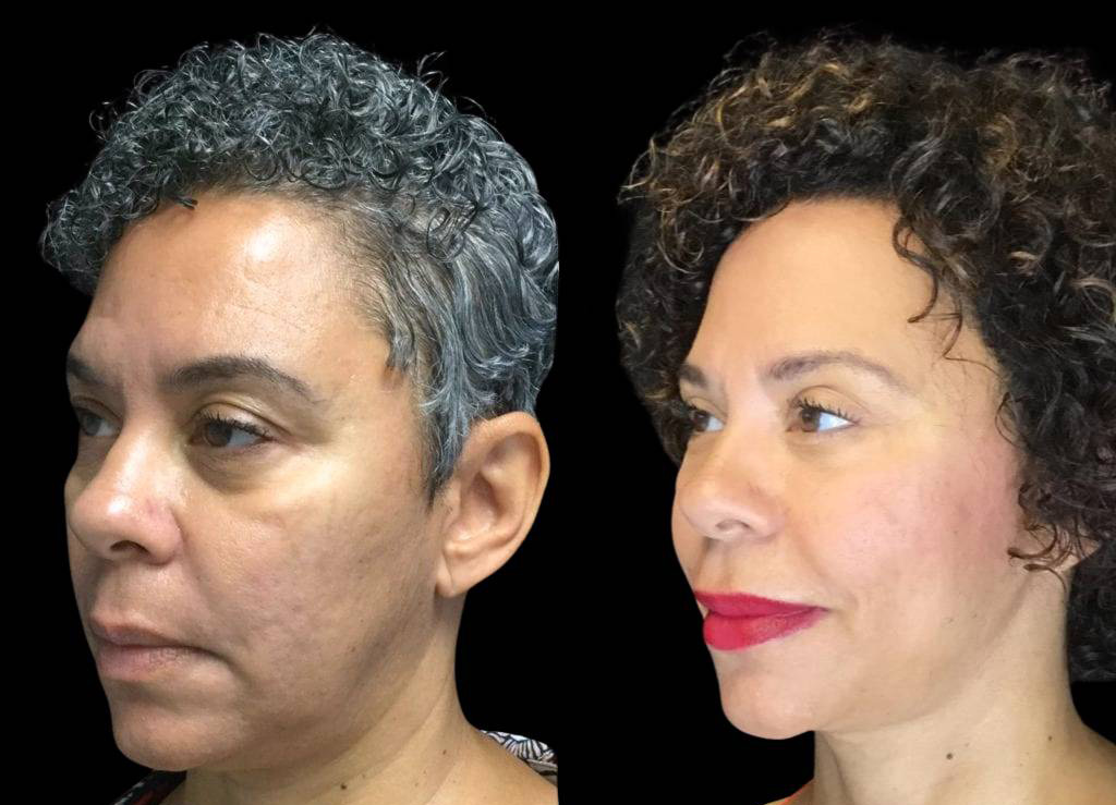 55-year-old-female-necklift-before-and-after-three-quarter-view.jpg