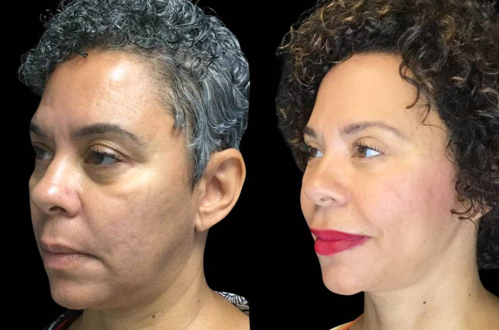 55-year-old-female-necklift-before-and-after-three-quarter-view.jpg