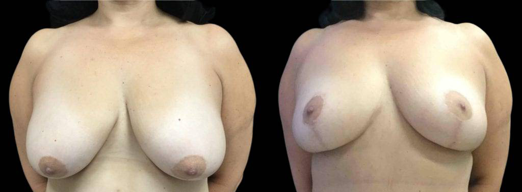 This is a 55-year-old female that has had a tummy tuck showing the before and after's side-by-side