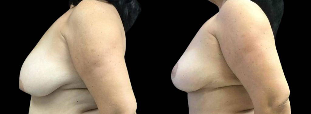 This is a 55-year-old female that has had a tummy tuck showing the before and after's side-by-side