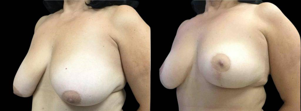 This is a 55-year-old female that has had a tummy tuck showing the before and after's side-by-side