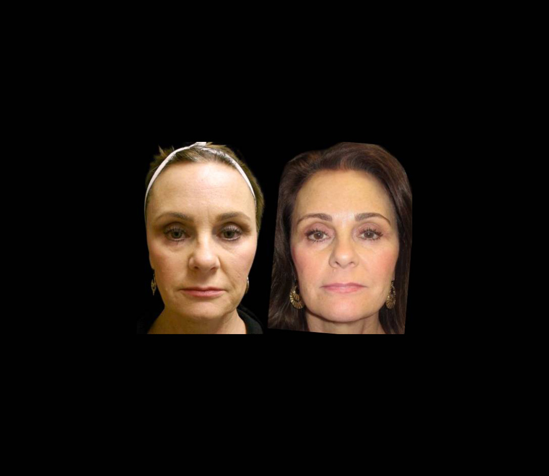 55-year-old-female-ultratherapy-before-and-after-1.jpg