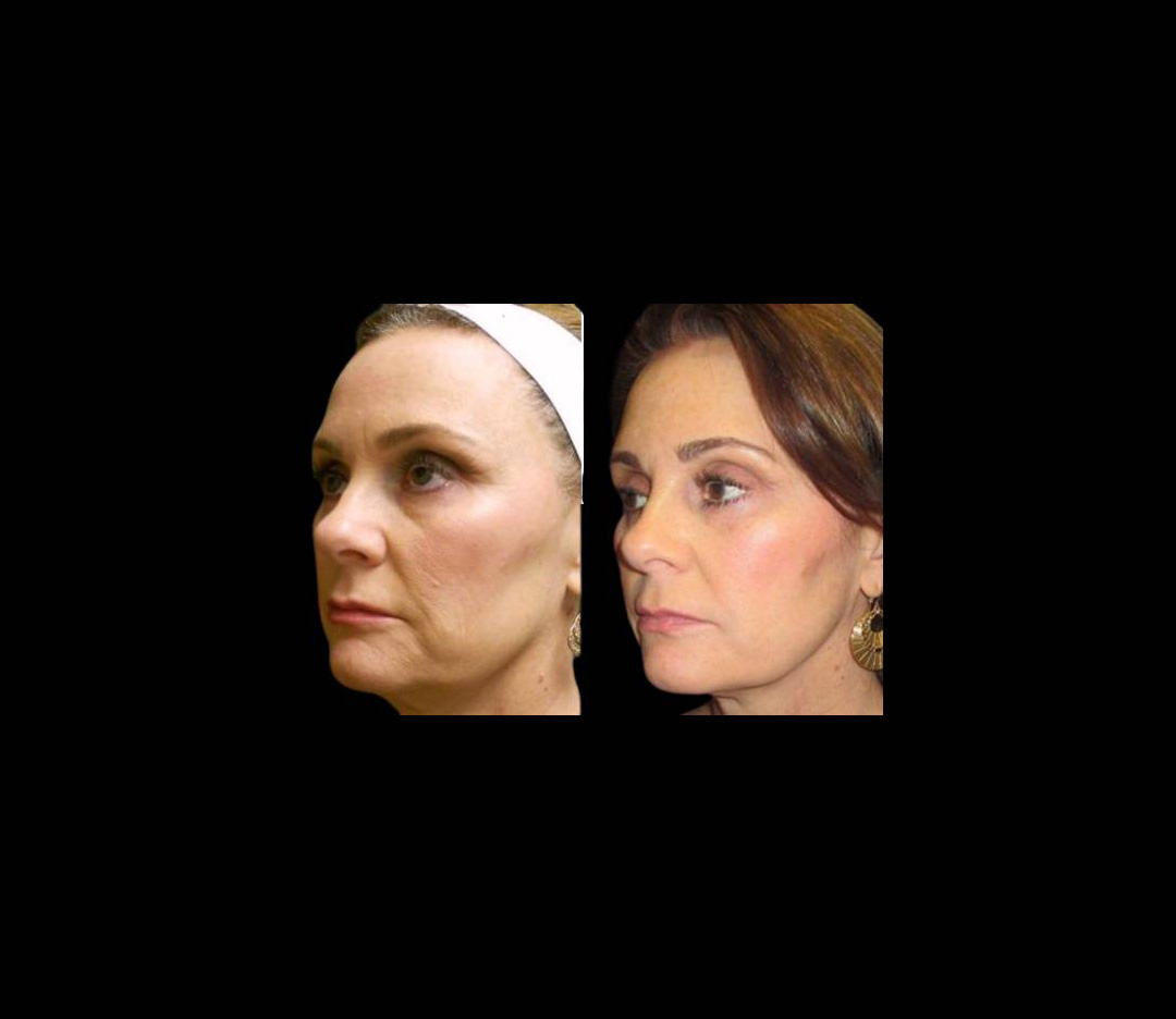 55-year-old-female-ultratherapy-before-and-after.jpg