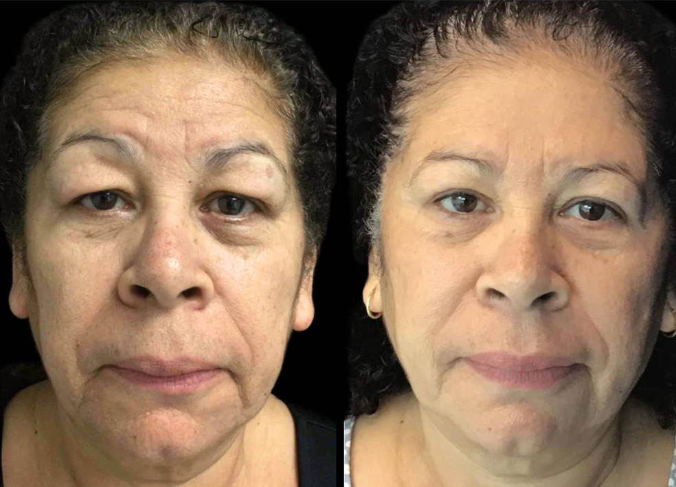 55-year-old-female-upper-and-lower-eyelid-lift-before-and-after-1-2-scaled.jpg