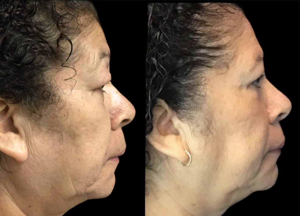 55-year-old-female-upper-and-lower-eyelid-lift-before-and-after-1-scaled.jpg