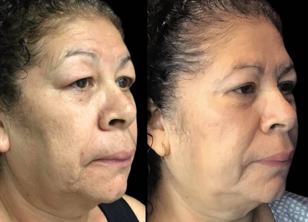 55-year-old-female-upper-and-lower-eyelid-lift-before-and-after-3-scaled.jpg