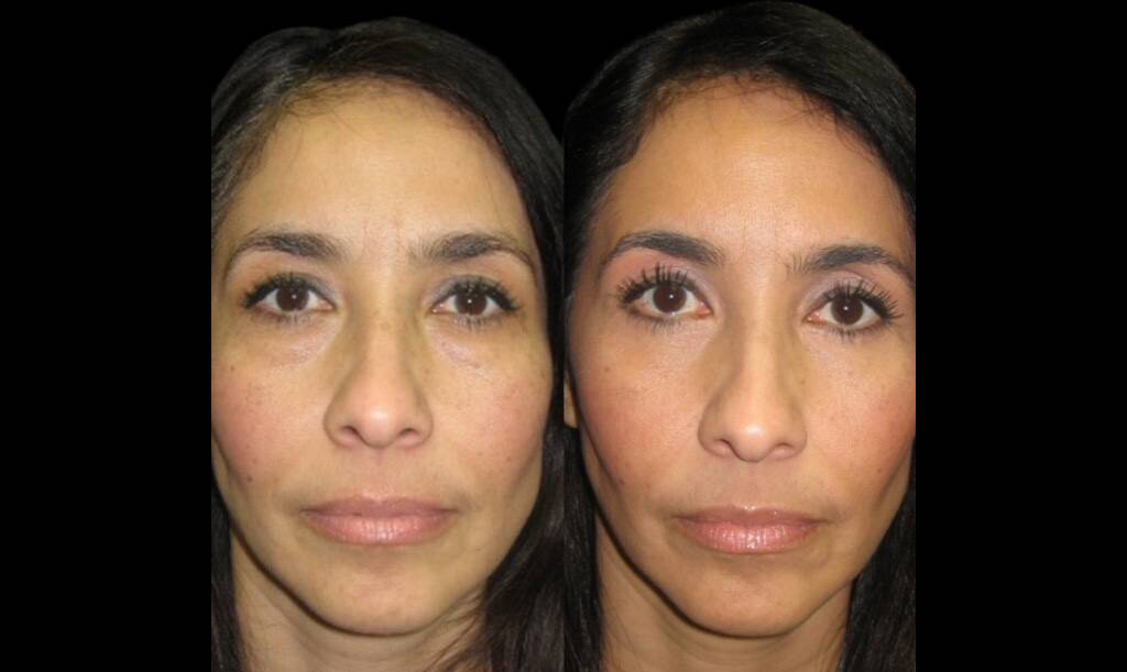55-year-old-female-upper-and-lower-eyelid-lift-before-and-after-front-view-1-1.jpg
