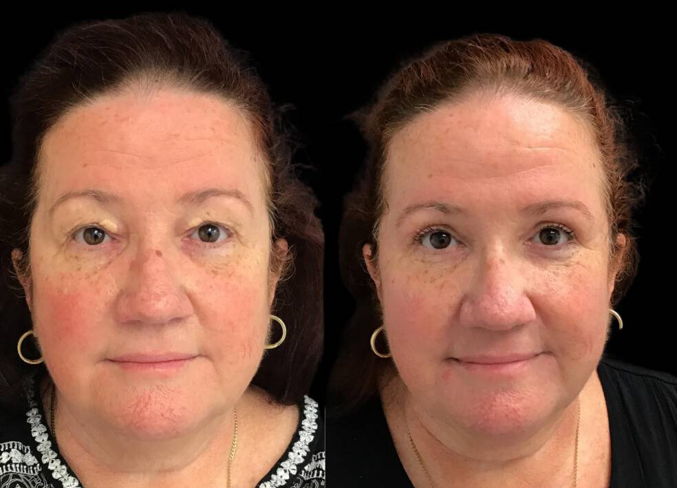 55-year-old-female-upper-and-lower-eyelid-lift-before-and-after-front-view-1-2.jpg