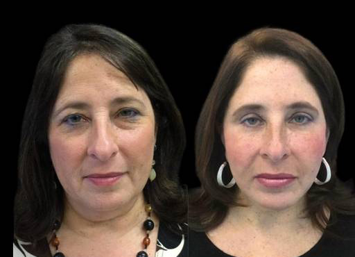 55-year-old-female-upper-and-lower-eyelid-lift-before-and-after-front-view-15979.jpg