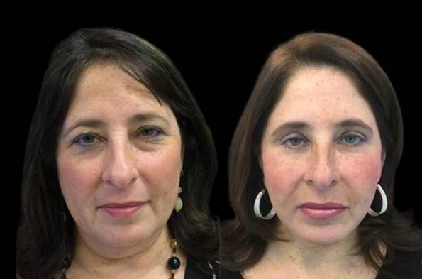 55-year-old-female-upper-and-lower-eyelid-lift-before-and-after-front-view-15979.jpg