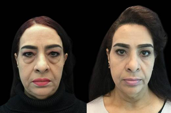 55-year-old-female-upper-and-lower-eyelid-lift-before-and-after-front-view-24246.jpg