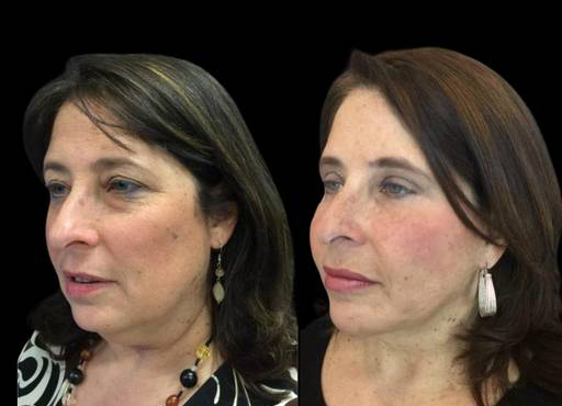 55-year-old-female-upper-and-lower-eyelid-lift-before-and-after-three-quarter-view-2.jpg