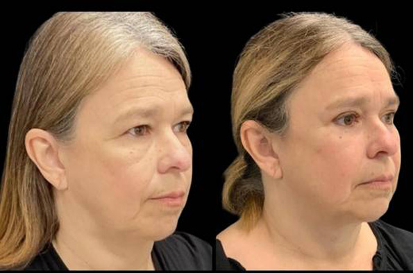 55-year-old-female-upper-and-lower-eyelid-lift-before-and-after-three-quarter-view-4.jpg