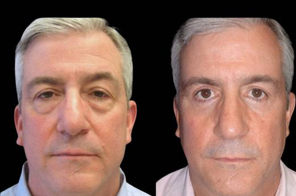 55-year-old-male-upper-and-lower-eyelid-lift-before-and-after-front-view-14614.jpg