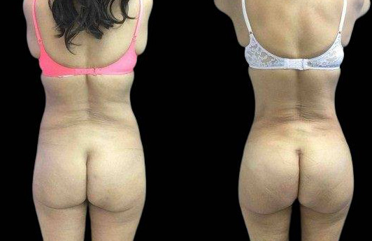 This is a 56-year-old female that has had a brazilian butt lift showing the before and after's side-by-side