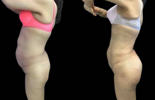 This is a 56-year-old female that has had a brazilian butt lift showing the before and after's side-by-side