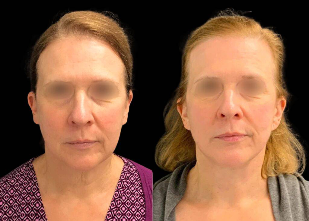 56-year-old-female-necklift-before-and-after-front-view-33395.jpg