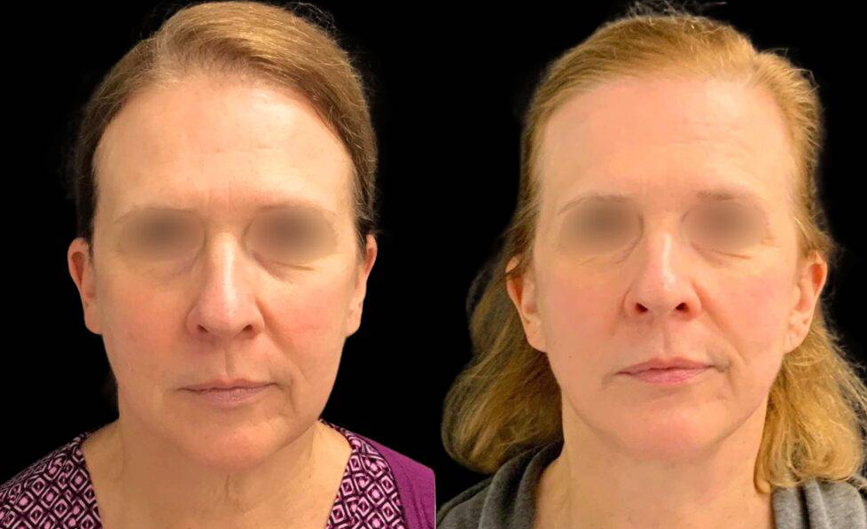 56-year-old-female-necklift-before-and-after-front-view-33395.jpg