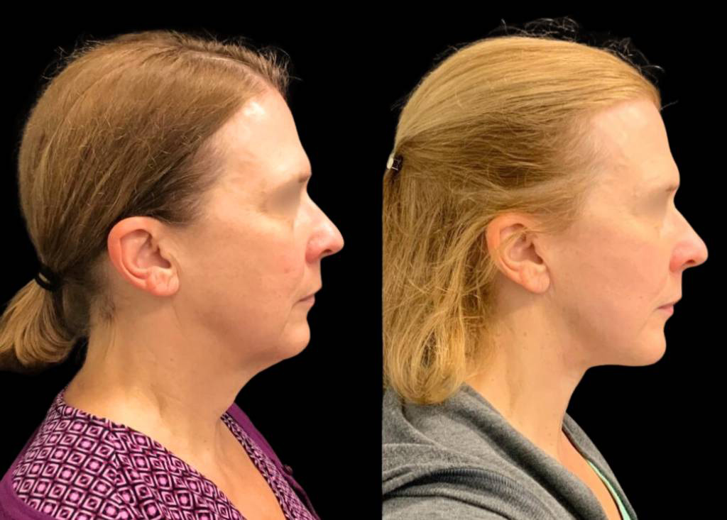 56-year-old-female-necklift-before-and-after-side-view.jpg