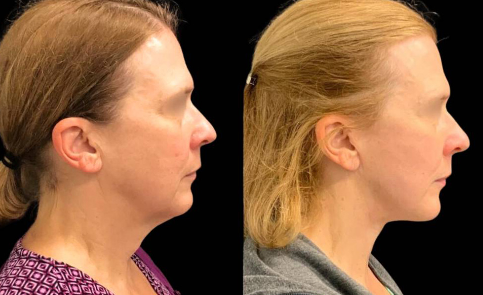 56-year-old-female-necklift-before-and-after-side-view.jpg