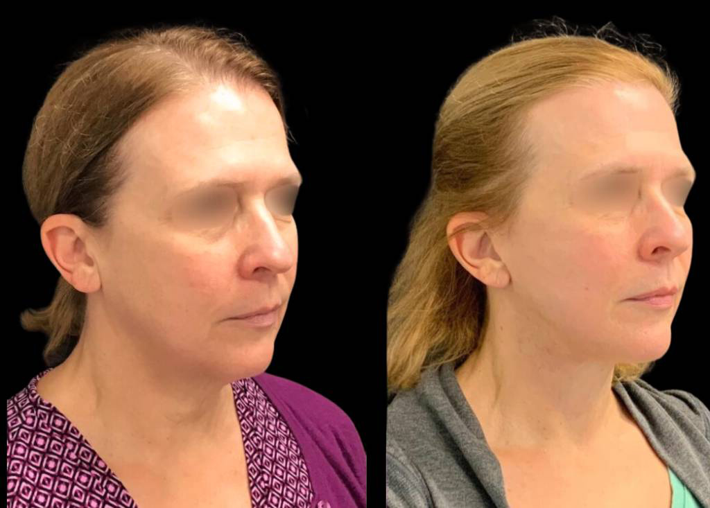 56-year-old-female-necklift-before-and-after-three-quarter-view.jpg