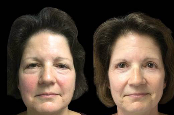 56-year-old-female-upper-and-lower-eyelid-lift-before-and-after-front-view-21370.jpg