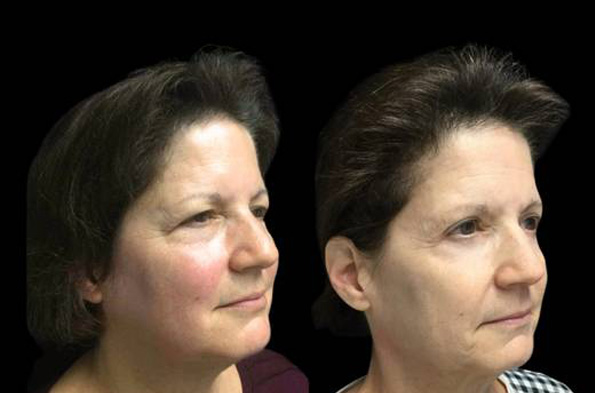 56-year-old-female-upper-and-lower-eyelid-lift-before-and-after-three-quarter-view.jpg