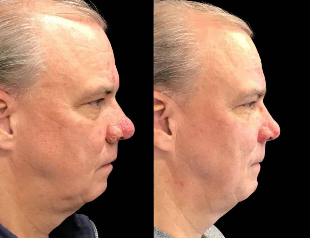 56-year-old-male-dermabrasian-before-and-after-side-view.jpg