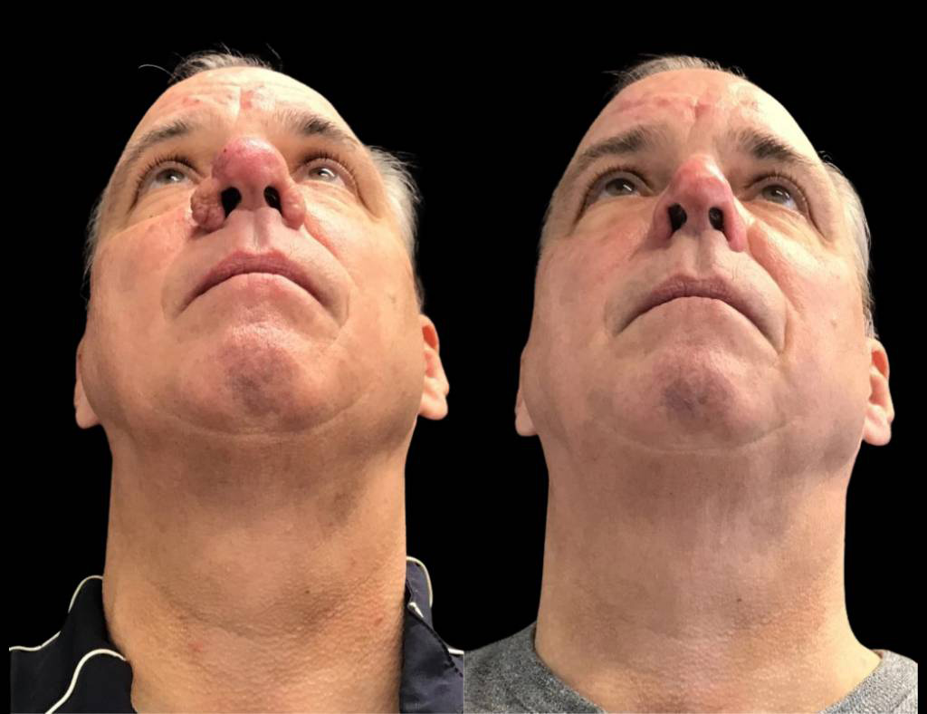 56-year-old-male-dermabrasian-before-and-after-under-view.jpg