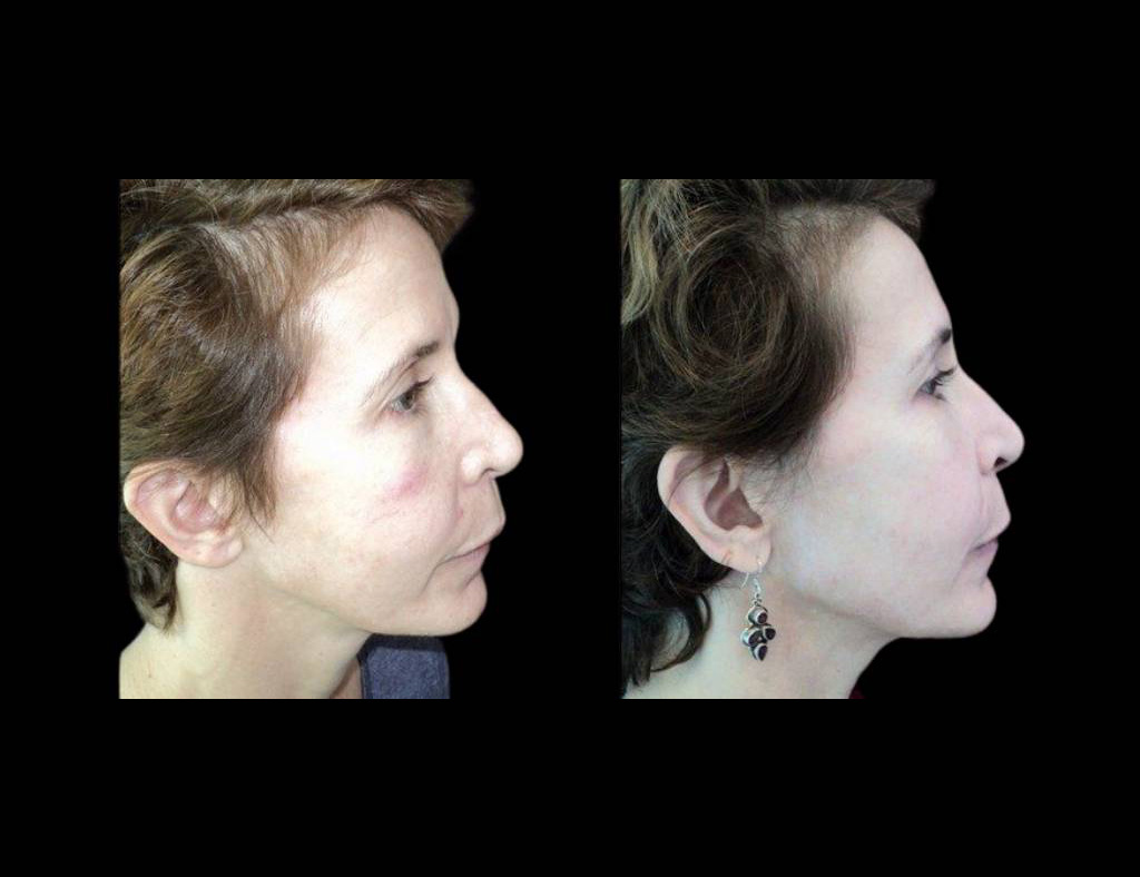 57-year-old-female-bbl-photo-rejuvenation-before-and-after-side-view-13361.jpg