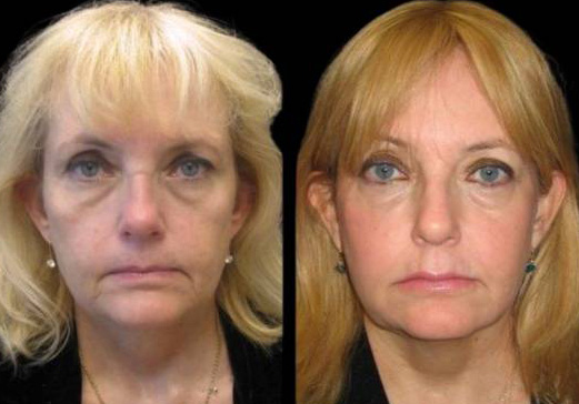 57-year-old-female-non-surgical-facelift-before-and-after-1.jpg