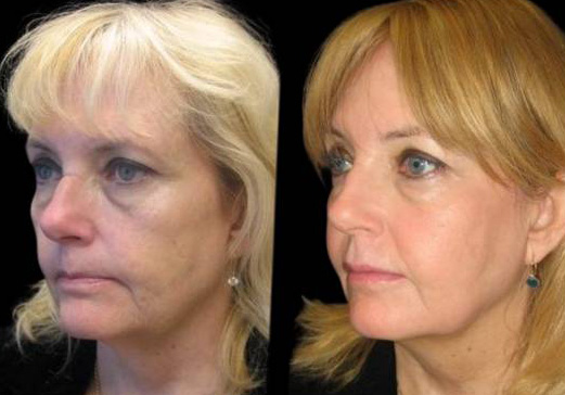 57-year-old-female-non-surgical-facelift-before-and-after.jpg