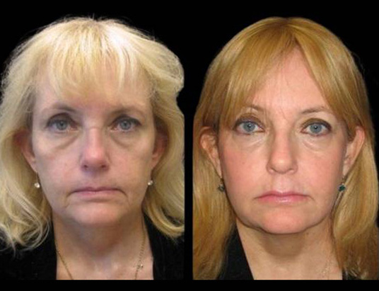 57-year-old-female-non-surgical-facelift-before-and-after-1.jpg